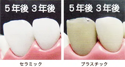 セラミックとプラスチックの違い