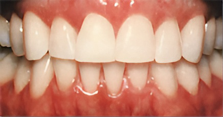 ホワイトニング後