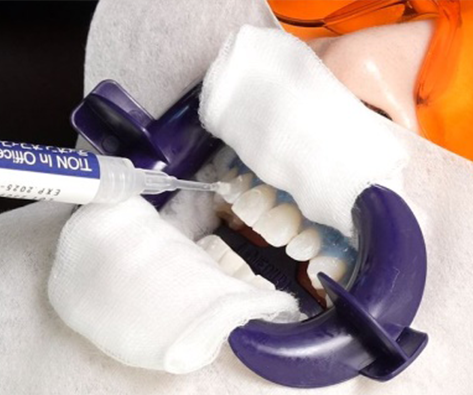 オフィスホワイトニング