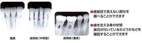 歯周病X線写真検査